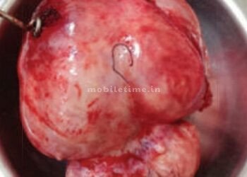 ಆಕೆಯ ಗರ್ಭದಲ್ಲಿತ್ತು 5 ಕೆಜಿಯ ಗಡ್ಡೆ!