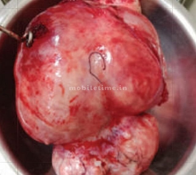 ಗರ್ಭದಲ್ಲಿದ್ದ 5.6 ಕೆಜಿ ಗಾತ್ರದ ಗಡ್ಡೆ